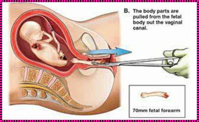 关于三个月引产的过程