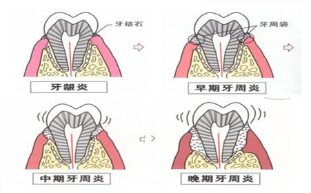 关于广东省口腔医院牙周炎的探讨