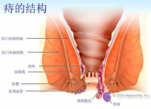 广东省介入栓塞治疗痔疮的探究