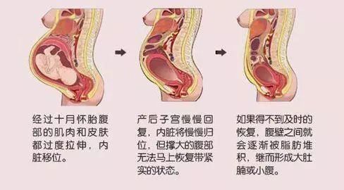 剖腹产三个月后肚子仍然很大的现象与恢复过程